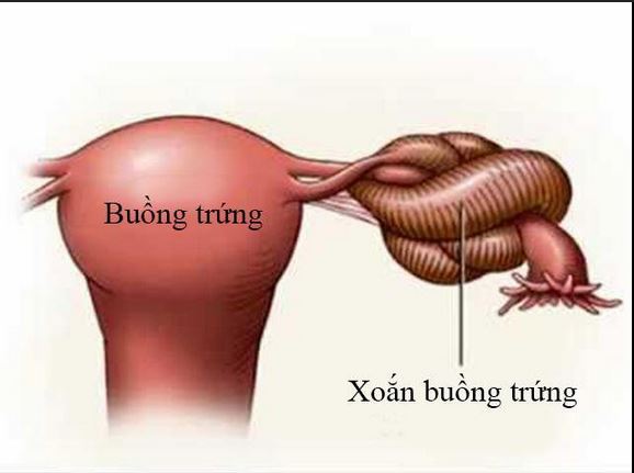 Cảnh Báo Về Xoắn U Nang Buồng Trứng: Triệu Chứng và Cách Điều Trị