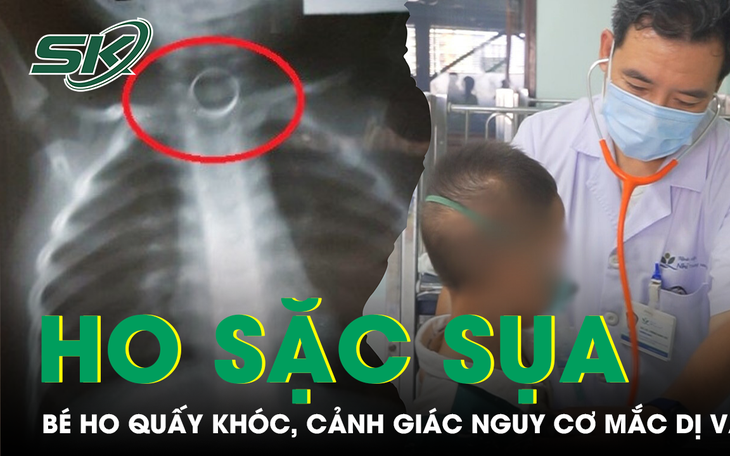 Nguy Cơ Từ Dị Vật Đường Thở: Câu Chuyện Của Một Bệnh Nhân Bị Xương Cá Mắc Kẹt- Ảnh 3.