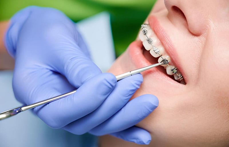 Giải Đáp Về Vấn Đề Hóp Má Khi Niềng Răng Và Cách Giải Quyết- Ảnh 2.