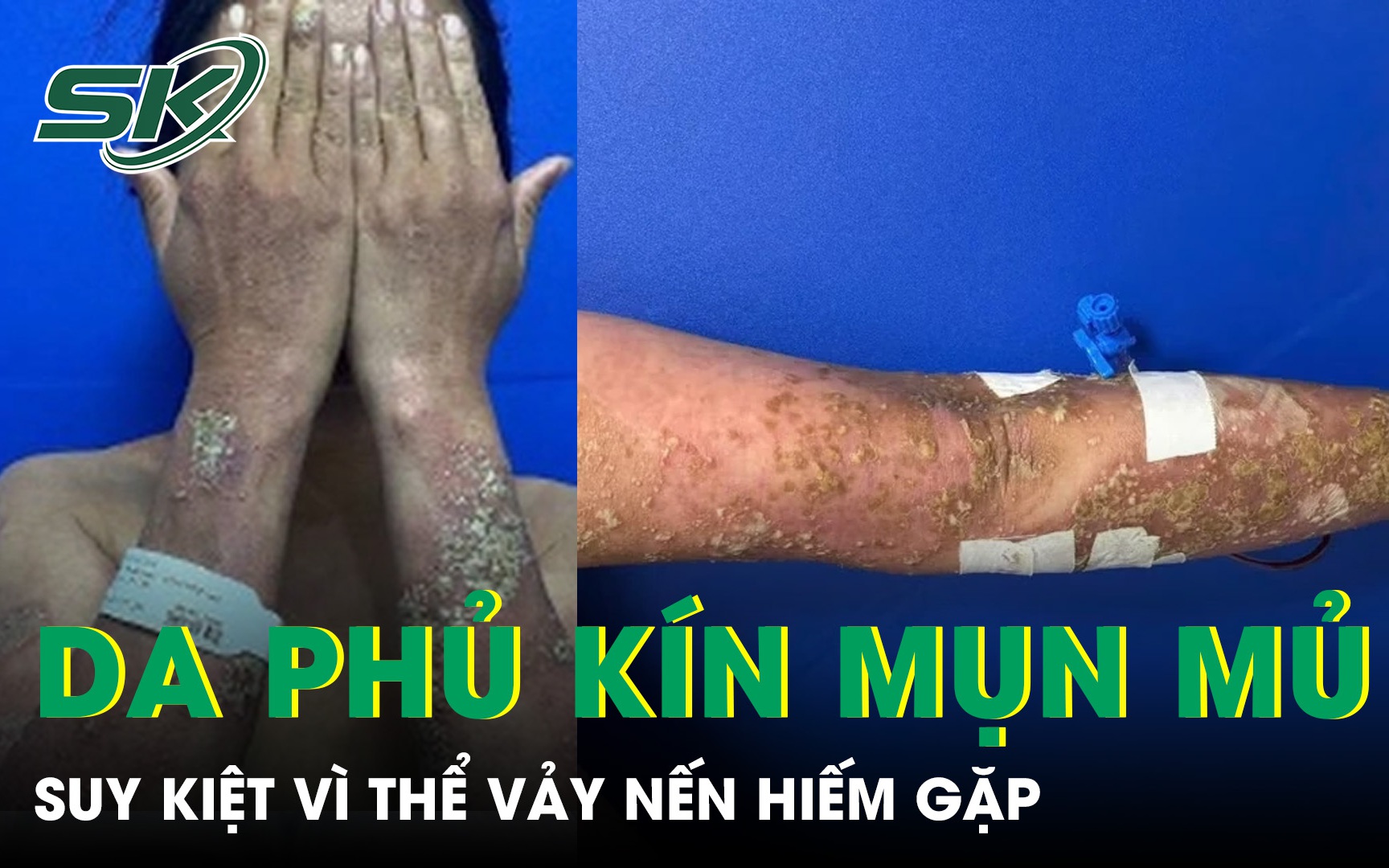 Cảnh Giác Về Tình Trạng Tổn Thương Da Do Tự Ý Sử Dụng Thuốc Trong Điều Trị Vảy Nến