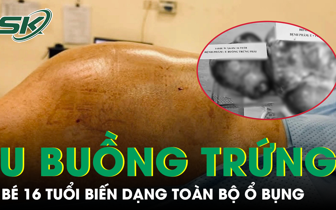 Tìm Hiểu Về Những Biểu Hiện Bất Thường Ở Bé Gái Từ Khối U Buồng Trứng
