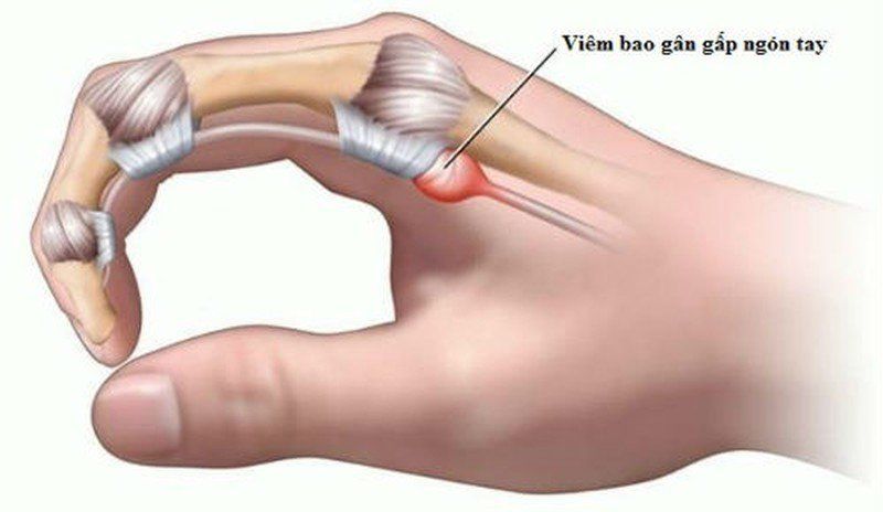 Hiểu Về Viêm Gân Gấp Ngón Tay: Triệu Chứng và Nguyên Nhân Cần Biết