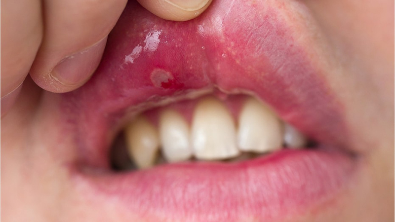 Chăm sóc sức khỏe răng miệng cho ngưởi mắc lupus