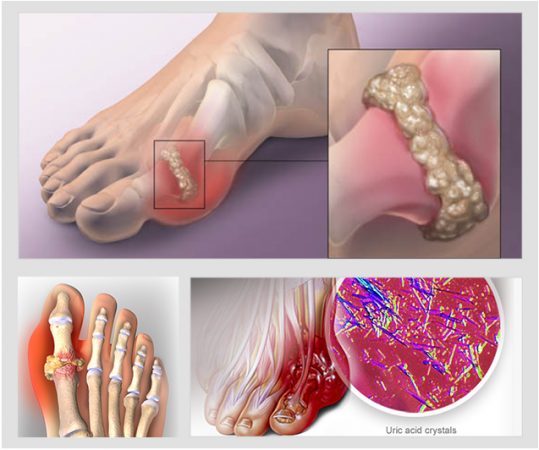 Acid Uric Cao: Nguyên Nhân và Tác Động Đến Sinh Lý Nam Giới