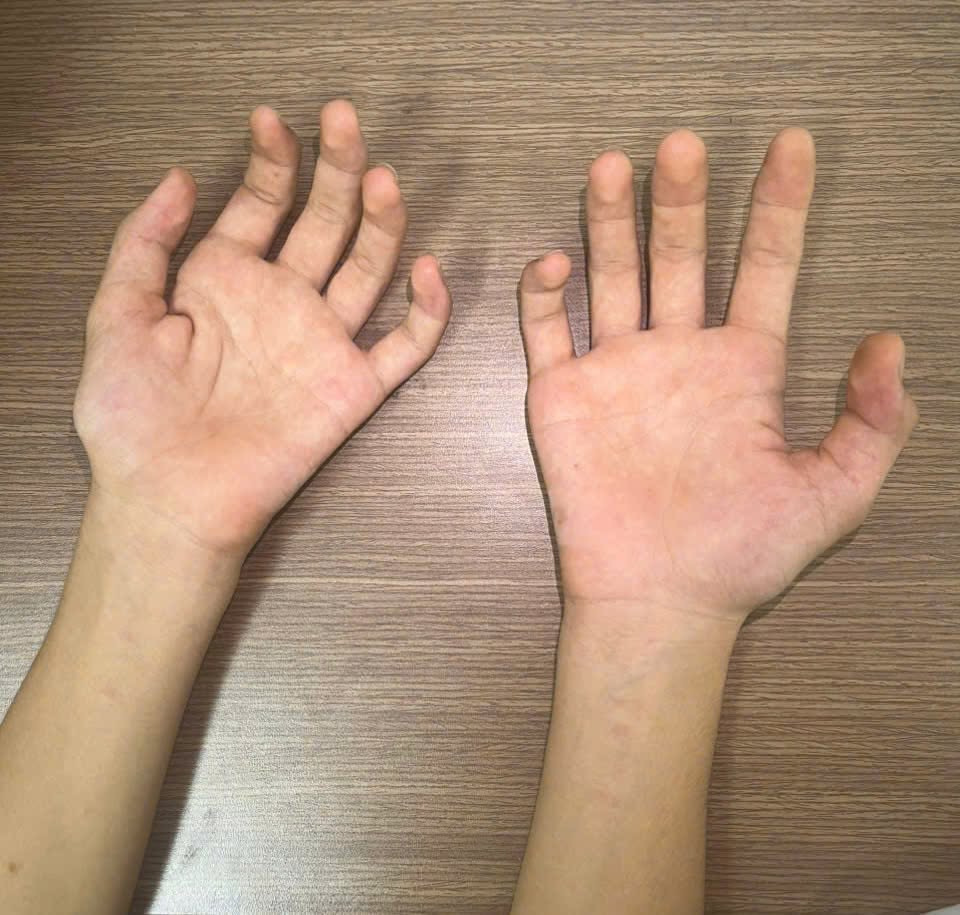 Nhận Diện Bệnh Hirayama: Triệu Chứng và Phương Pháp Điều Trị - Ảnh 2.