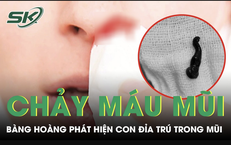 Chấn thương mắt do móc câu: hướng xử trí kịp thời và cách phòng ngừa để giữ thị lực