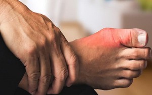 Cách Chạy Bộ An Toàn Cho Người Bị Gout: Kiểm Soát Cơn Đau Và Tái Phát