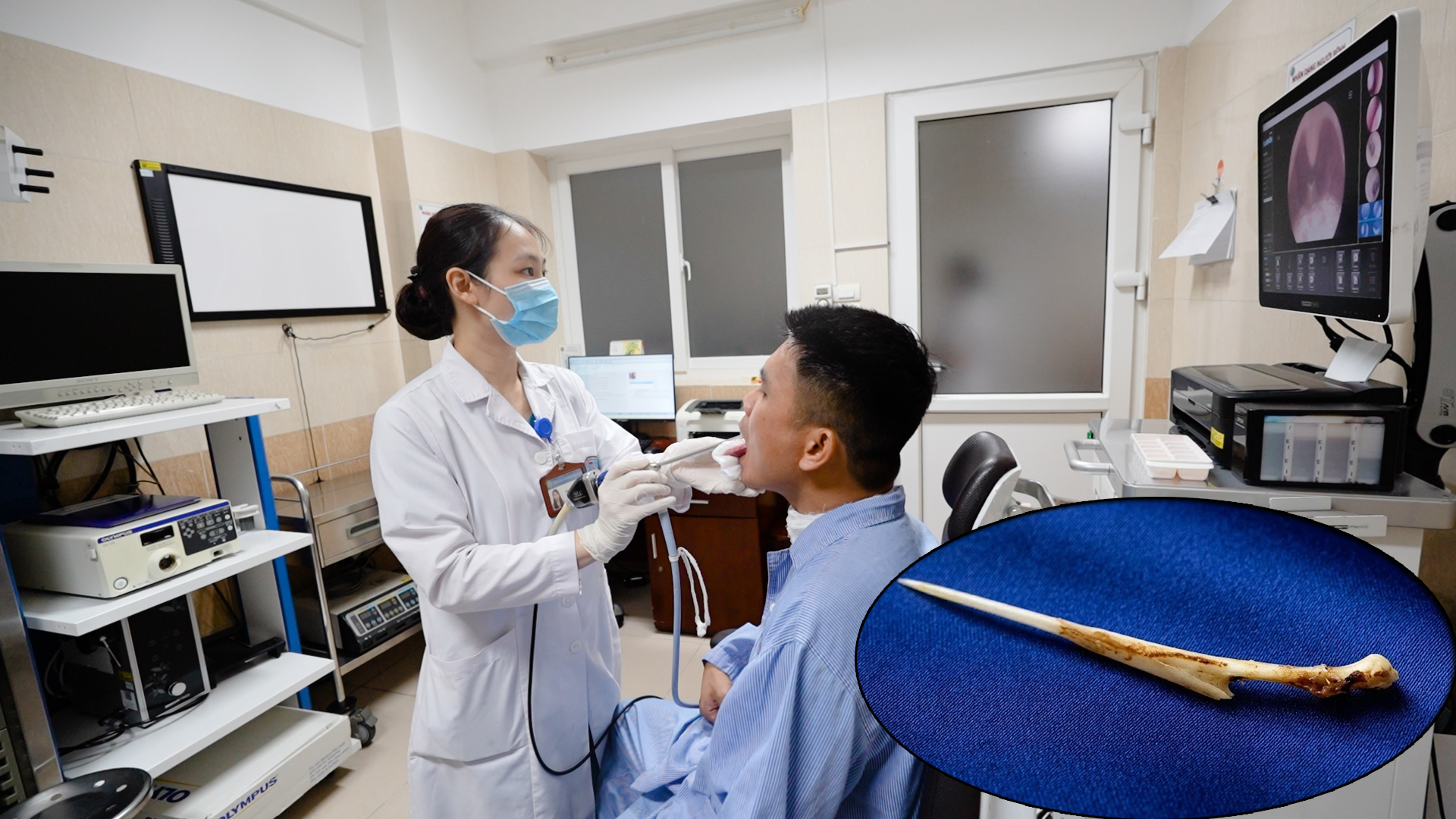 Nguy Cơ Từ Việc Cố Nuốt Khi Hóc Xương: Câu Chuyện Của Một Bệnh Nhân