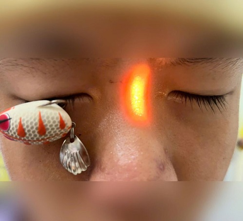 Móc câu xuyên thủng mắt, bé trai 13 tuổi nguy cơ ảnh hưởng thị lực lâu dài - Ảnh 1.