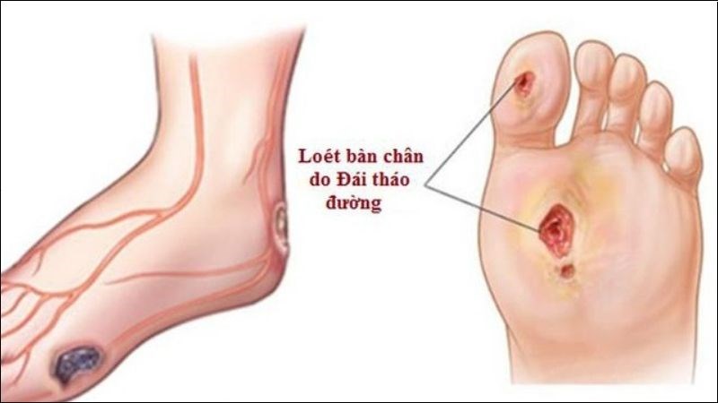 Tê bì ở bàn chân do tiểu đường: nhận biết sớm và những bước chăm sóc cần làm