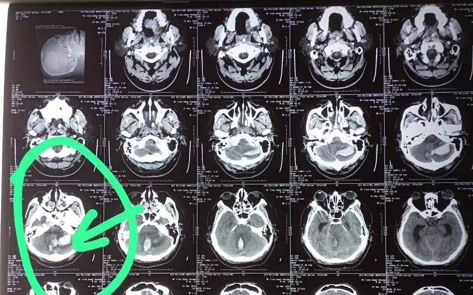 Hành Trình Tìm Lại Cuộc Sống Sau Biến Chứng Sau Sinh Của Người Mẹ Lào