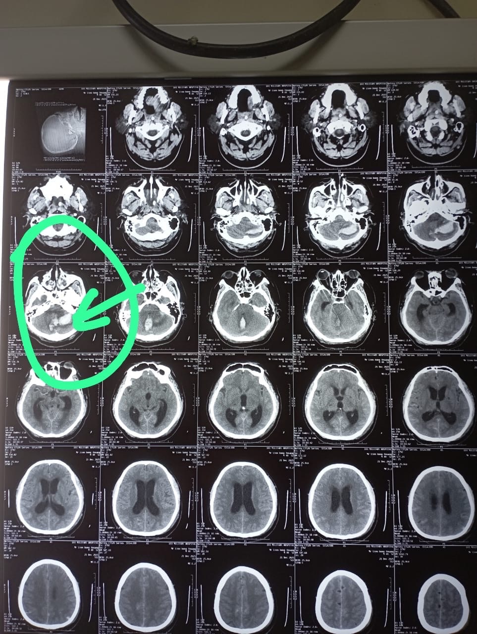 Hình ảnh phim chụp CT sọ não cho thấy một ổ chảy máu lớn ở tiểu não.