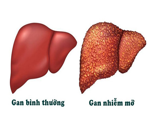 Khám Phá Tình Trạng Gan Nhiễm Mỡ: Xét Nghiệm và Phương Pháp Điều Trị