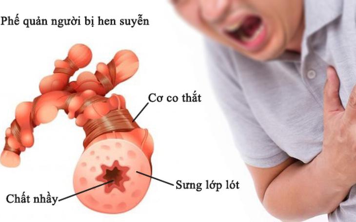 Lựa Chọn Thể Thao Đối Với Người Bị Hen Phế Quản