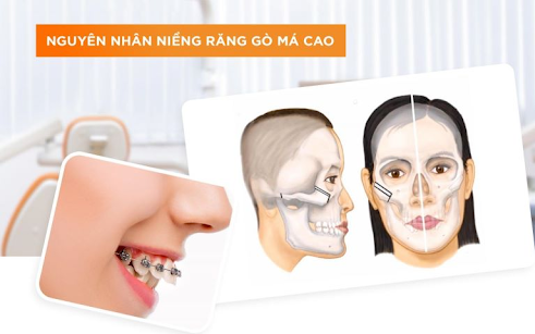 Giải Đáp Về Vấn Đề Hóp Má Khi Niềng Răng Và Cách Giải Quyết