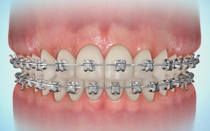 Giải Đáp Về Vấn Đề Hóp Má Khi Niềng Răng Và Cách Giải Quyết- Ảnh 1.