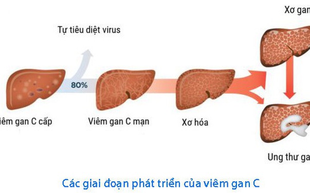 Những Thách Thức Trong Cuộc Chiến Chống Viêm Gan Virus Đến Năm 2030