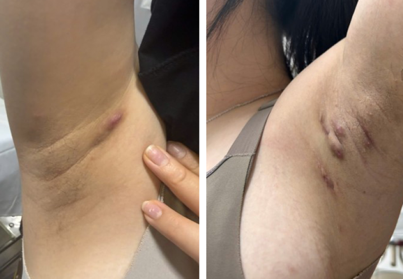 Nhận diện viêm tuyến mồ hôi mủ: khi ‘mụn nhọt’ tái phát cần đi khám