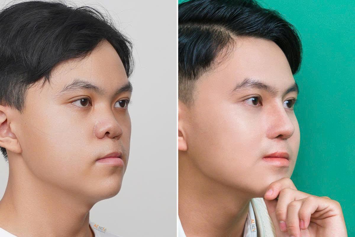 Những Trường Hợp Nào Cần Nâng Mũi Cấu Trúc?