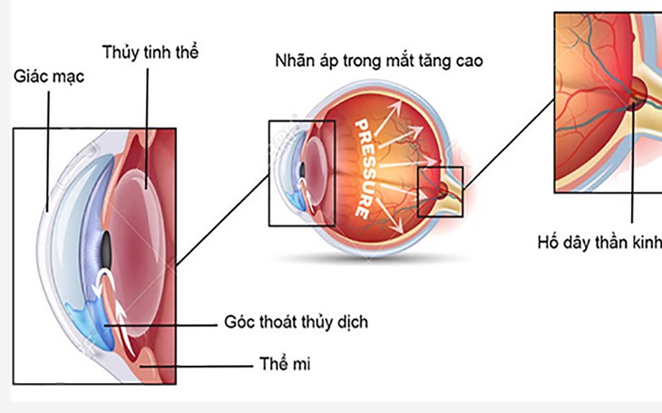 Khám Phá Vai Trò Của Vitamin B3 Trong Việc Giảm Nguy Cơ Glôcôm - Ảnh 2.