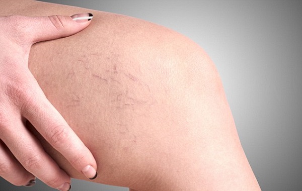 Những Biến Chứng Đáng Lo Ngại Của Suy Giãn Tĩnh Mạch Chân