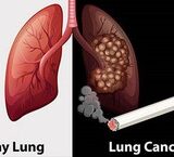Cảnh Báo Sức Khỏe: Bé 15 Tháng Nuốt Phải Nam Châm Hình Trái Tim