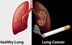Cảnh Báo Sức Khỏe: Bé 15 Tháng Nuốt Phải Nam Châm Hình Trái Tim