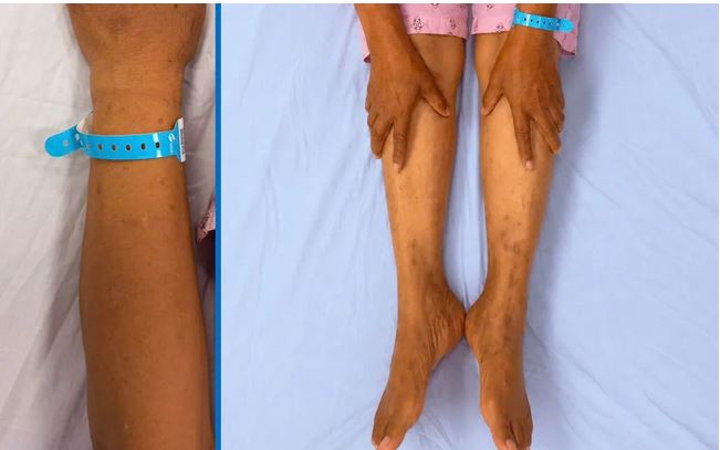 Nhận Biết Dấu Hiệu Tổn Thương Gan Để Bảo Vệ Sức Khỏe