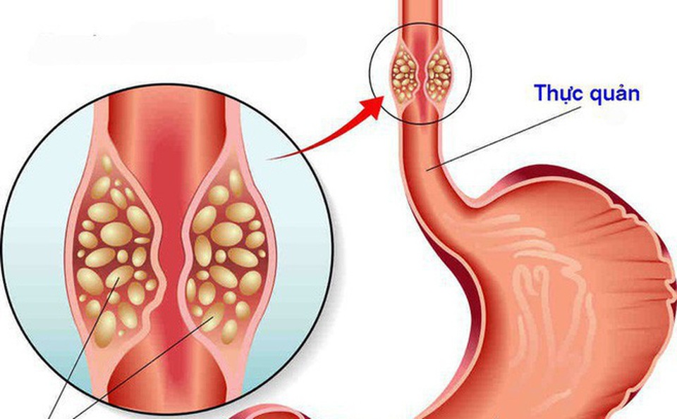 Những Dấu Hiệu Quan Trọng Của Hẹp Thực Quản Mà Bạn Không Nên Bỏ Qua