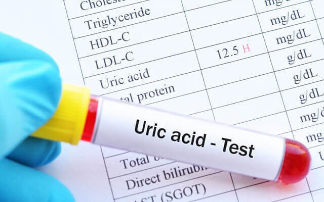 Mật Ong và Nước Chanh: Những Điều Cần Biết Về Tác Động Đến Acid Uric - Ảnh 3.
