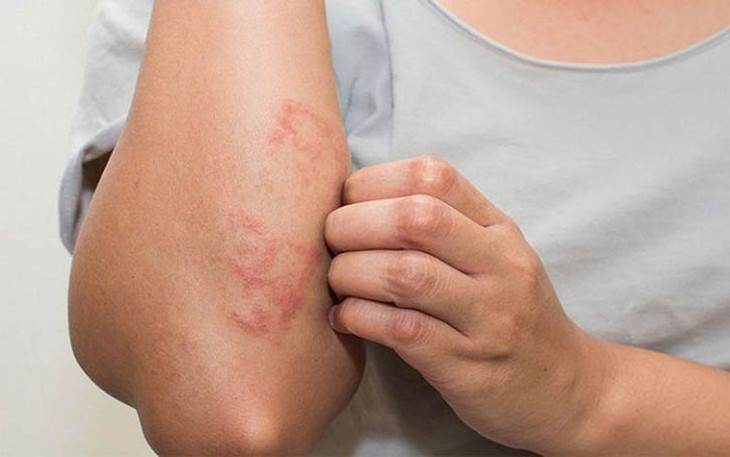 7 Thói quen quan trọng giúp kiểm soát viêm da cơ địa- Ảnh 1.