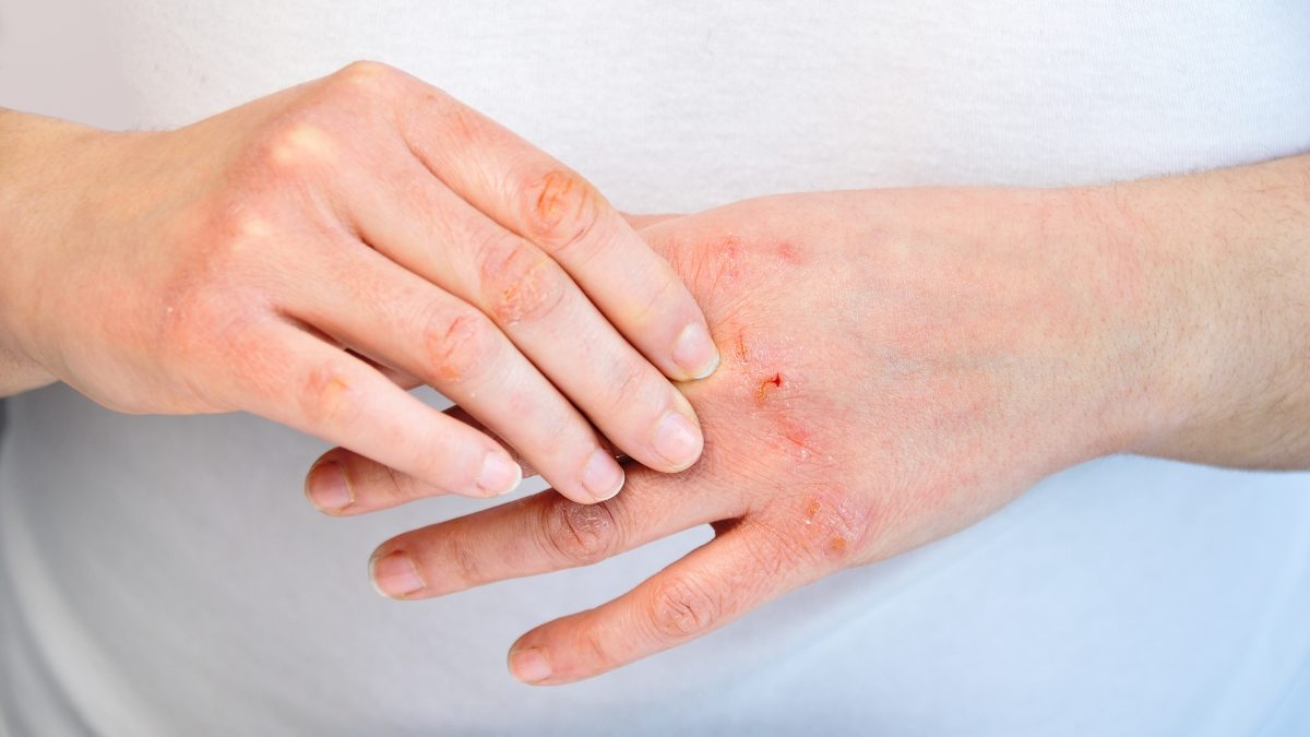 7 Thói quen quan trọng giúp kiểm soát viêm da cơ địa- Ảnh 2.