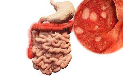 Viêm ruột đang trở thành vấn đề sức khỏe phổ biến