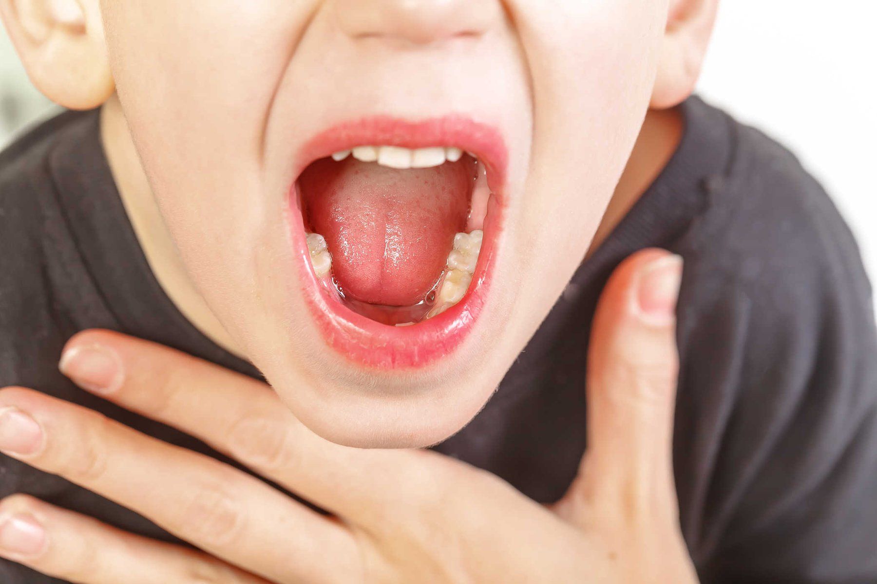 Hiểu Về Viêm VA: Triệu Chứng, Nguyên Nhân và Biến Chứng Ở Trẻ Em