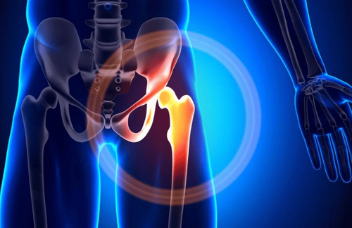 Các Dấu Hiệu Cảnh Báo Viêm Khớp Háng Ở Trẻ Em Mà Cha Mẹ Phải Nhận Diện