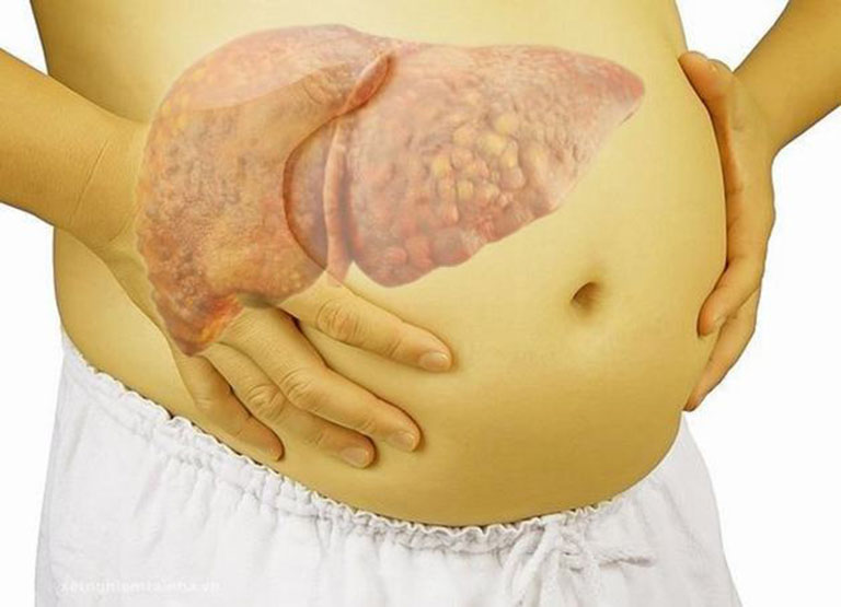 Xơ gan có dẫn đến ung thư gan? Hiểu biết đúng để phòng bệnh hiệu quả - Ảnh 1.