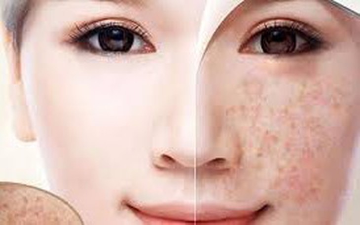 Khám Phá Đốm Đồi Mồi: Liệu Nước Cốt Chanh Có Thực Sự Hiệu Quả?